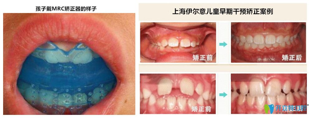 孩子戴MRC的樣子以及伊爾意孩子矯正的前后對比照