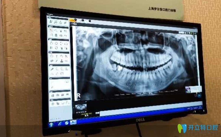 在<!--<i data=20240703-sp></i>-->伊爾意檢查牙齒時候拍的牙片