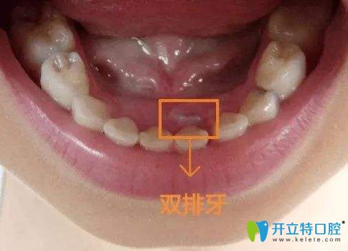 孩子長出雙排牙只因為麻麻犯了一個錯誤你敢信？