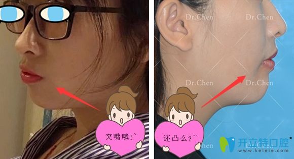 兔牙女孩的牙套故事:做ormco陶瓷自鎖托槽矯正760天......