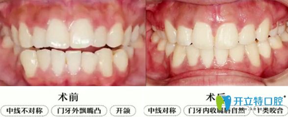 上排門牙外凸開頜隱適美牙套矯正2年畢業(yè)啦,大波對(duì)比圖來襲