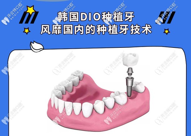 種植牙價格表