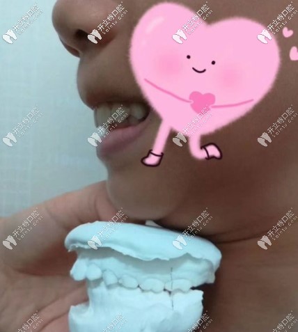 8歲女兒齙牙在常德武陵區(qū)口腔醫(yī)院戴羅慕誘導矯正器1年了