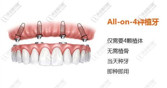 allon4種植技術(shù)只需4顆種植體