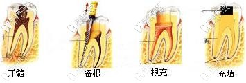 開髓、備根、根充以及填充