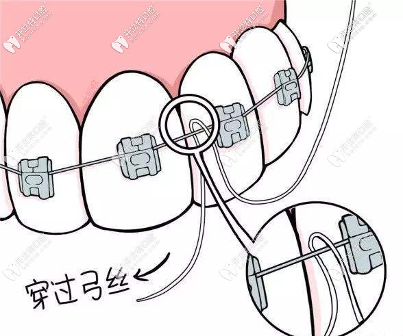 帶牙套需要換多少次弓絲