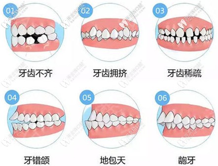 六種牙齒畸形的情況都適合做鋼牙套