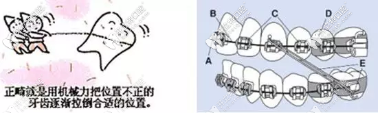 正畸中弓絲的種類有哪些