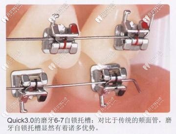 自鎖式托槽矯正器