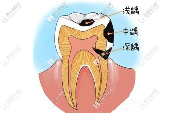 崔巧明醫(yī)生提醒大家補牙宜早不宜遲