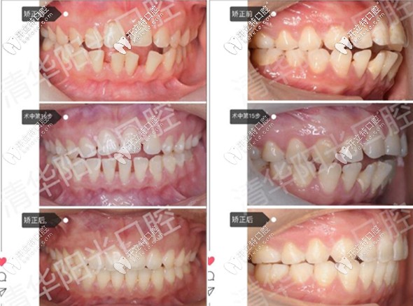 牙齒稀疏+扭轉(zhuǎn)開頜,打卡武漢清華陽光口腔隱適美不拔牙矯正