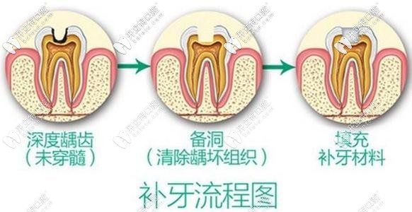 蛀牙別拖久喲!偷偷告訴你杭州做3M樹(shù)脂補(bǔ)牙的價(jià)格在這！