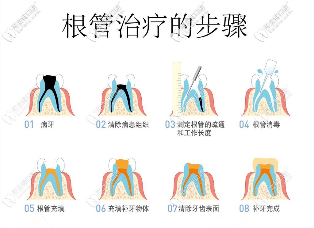 根管治療詳細過程