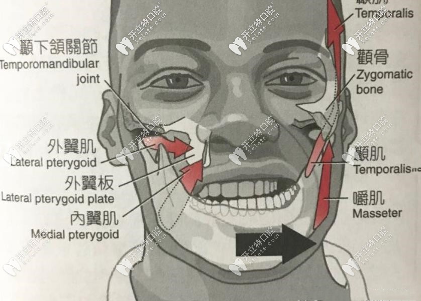 什么是穿顴穿翼種植牙技術(shù)?穿顴穿翼種植牙示意圖讓你秒懂