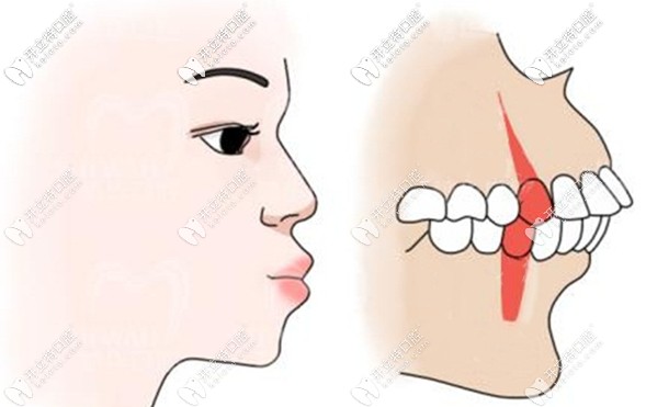 口腔正頜需要正畸和正頜醫(yī)生聯(lián)合會診