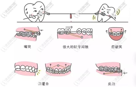 關(guān)于正畸支抗釘?shù)目破罩R(shí)