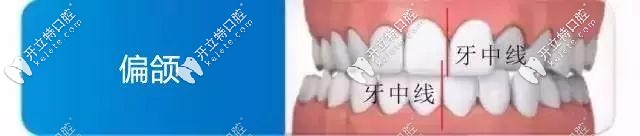 中線對齊才是正確的牙齒關(guān)系