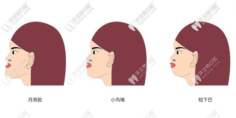 牙齒不齊造成的臉型問題