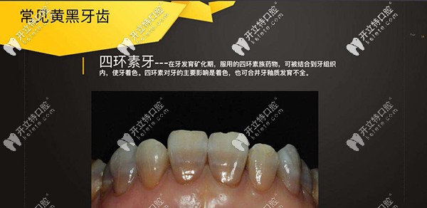做四環(huán)素牙牙齒漂白多少錢？做出來不知道效果好不好？