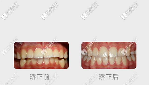 南京博韻口腔做金屬托槽矯正的案例