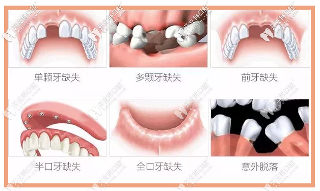 瑞典諾貝爾種植系統(tǒng)適應(yīng)癥