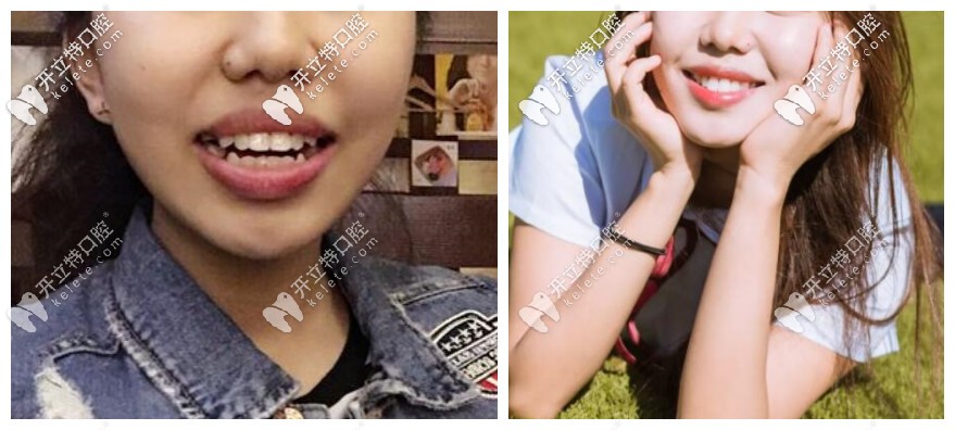 分享帖:北京禾禾齒科張棟梁做隱適美矯正怎么樣?收費貴不
