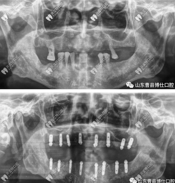 記錄在菏澤曹縣做滿口即刻種植牙的經歷,附種牙價格表