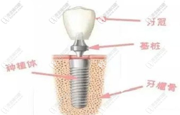 種植牙的組成部分