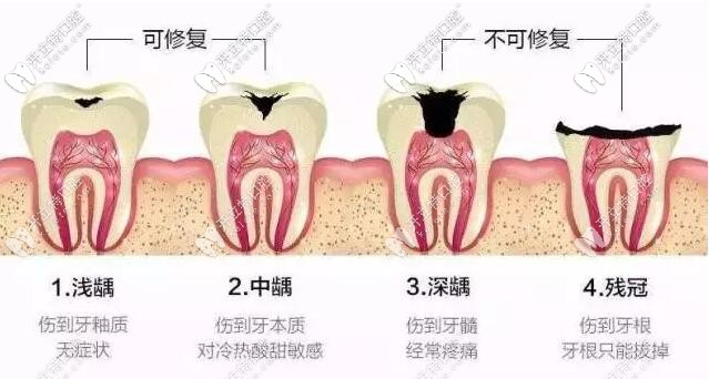 牙齒根管治療和打樁是一碼事嗎?