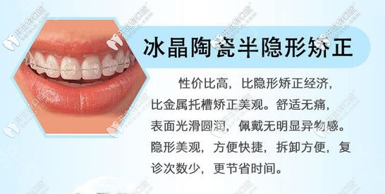 半隱形陶瓷牙齒矯正器優(yōu)勢