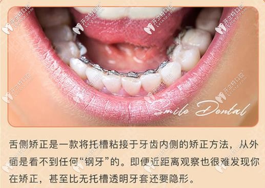 舌側隱形牙齒矯正好處