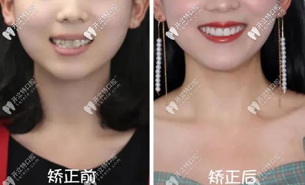 齙牙矯正