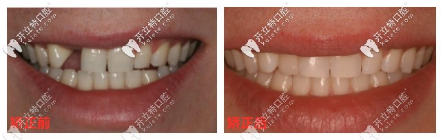 矯正前后對比
