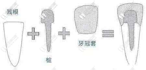 打樁補(bǔ)牙和鑲牙哪種效果好,大概能用多少年？