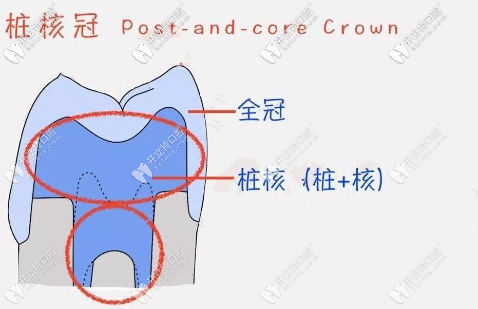 牙根剩4毫米可以做樁冠修復(fù)嗎?基本治療過程圖解你可以看看