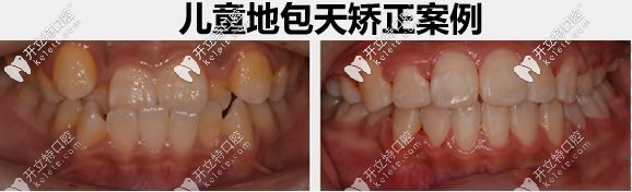 兒童地包天牙齒矯正前后