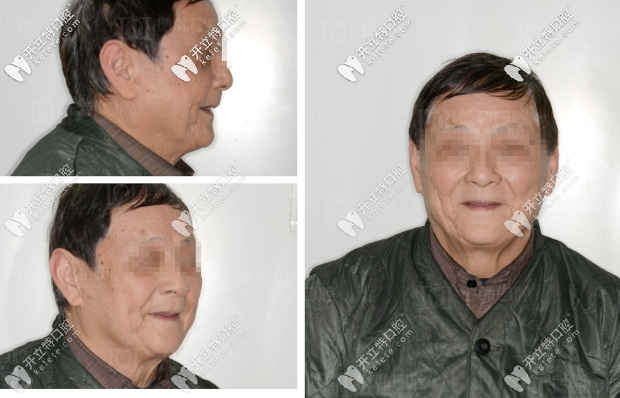 嘮嘮78歲爺爺全口缺失,在武漢德韓做即拔即種種植牙的流程