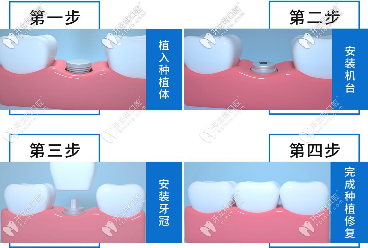 種植牙步驟圖解