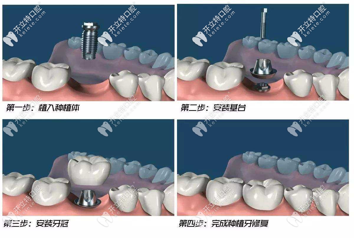 淚目！這份寶雞各口腔醫(yī)院價目表中，種牙、正畸收費不貴