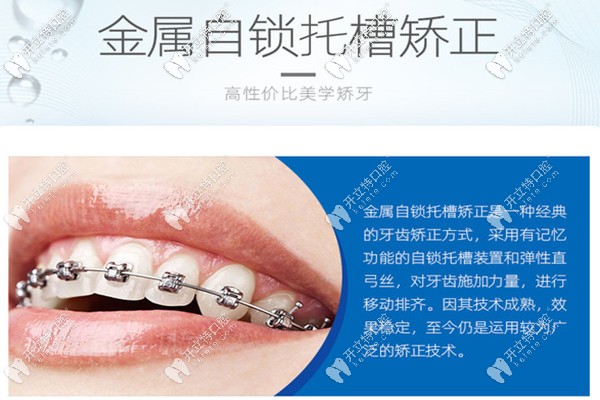 西安團(tuán)圓口腔自鎖托槽整牙技術(shù)