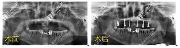 揭秘昆明汪大爺做allon4半口種植4顆牙的詳細(xì)步驟