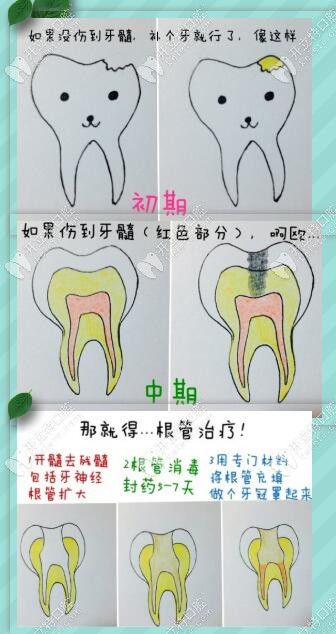 蛀牙不同程度的治療方式