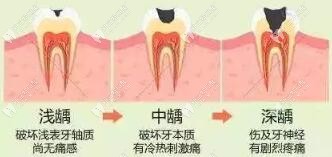 蛀牙發(fā)展程度