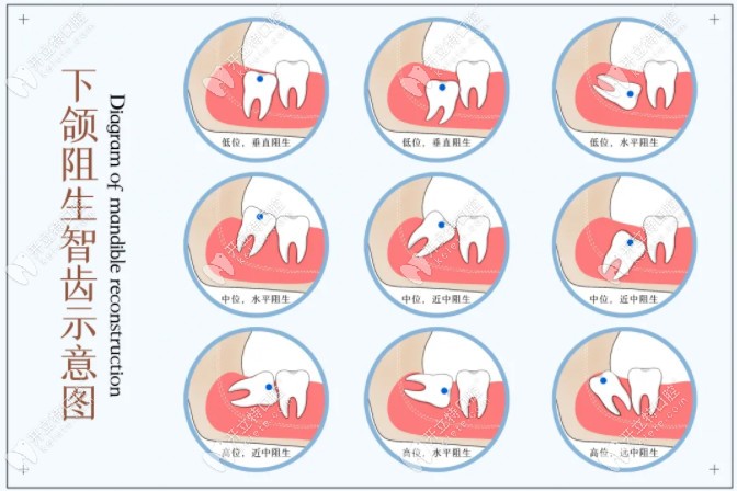 不同位置的智齒分類(lèi)
