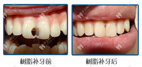 樹(shù)脂補(bǔ)牙前后對(duì)比
