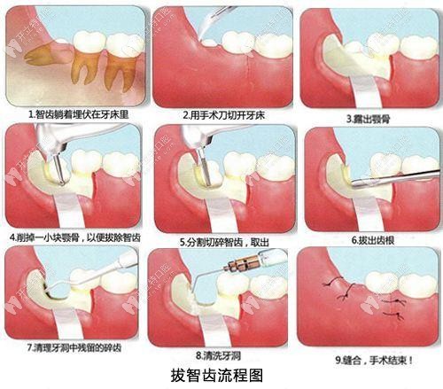 拔智齒的過程示意圖